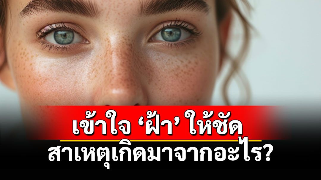 เข้าใจ ‘ฝ้า’ ให้ชัด สาเหตุที่เกิดมาจากอะไร?