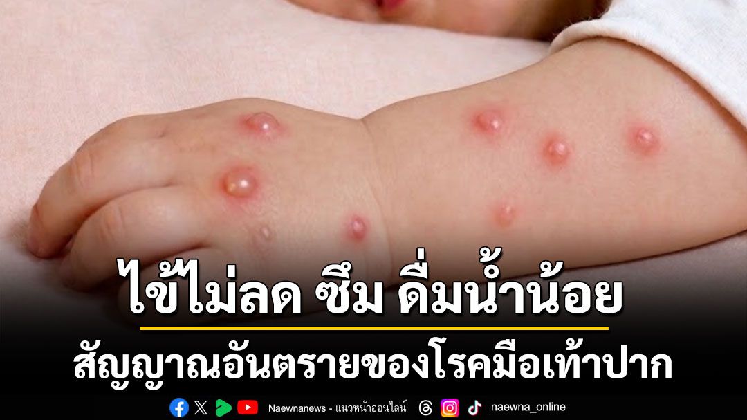 ไข้ไม่ลด ซึม ดื่มน้ำน้อย สัญญาณอันตรายของโรคมือเท้าปาก